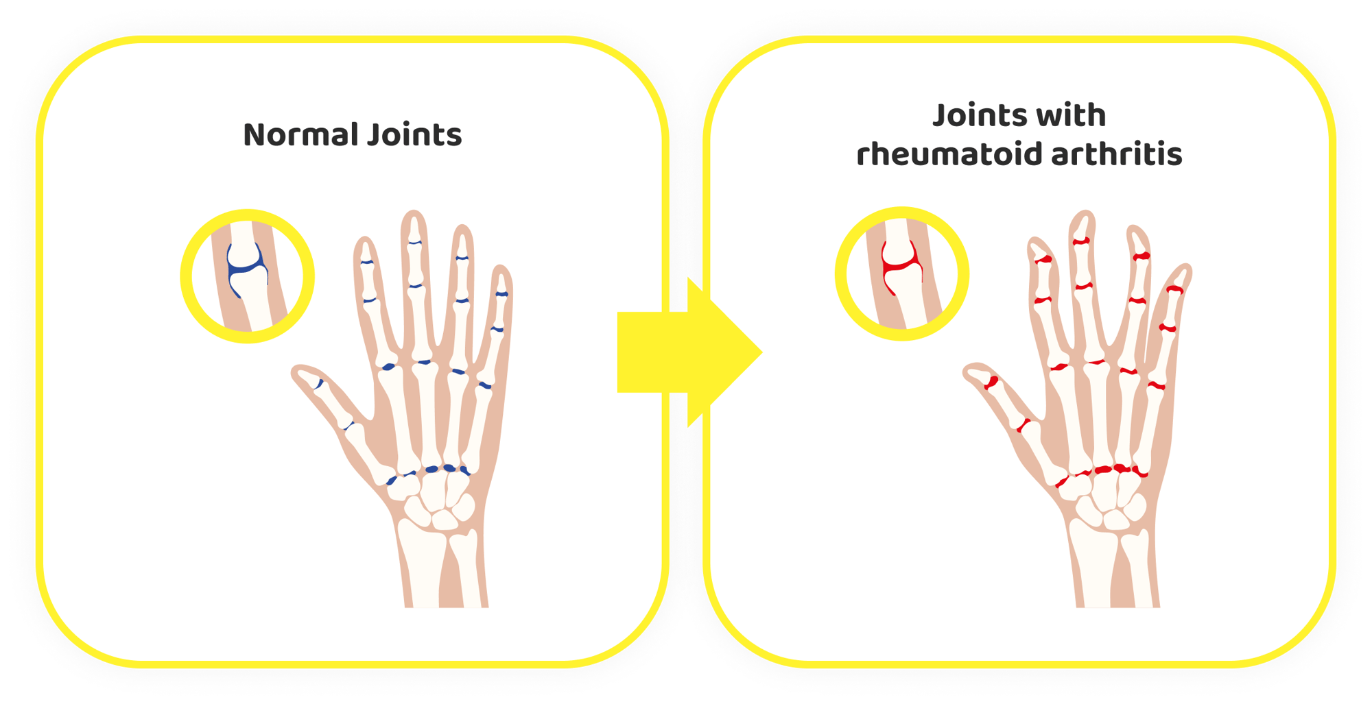 Rheumatoid Arthritis EN