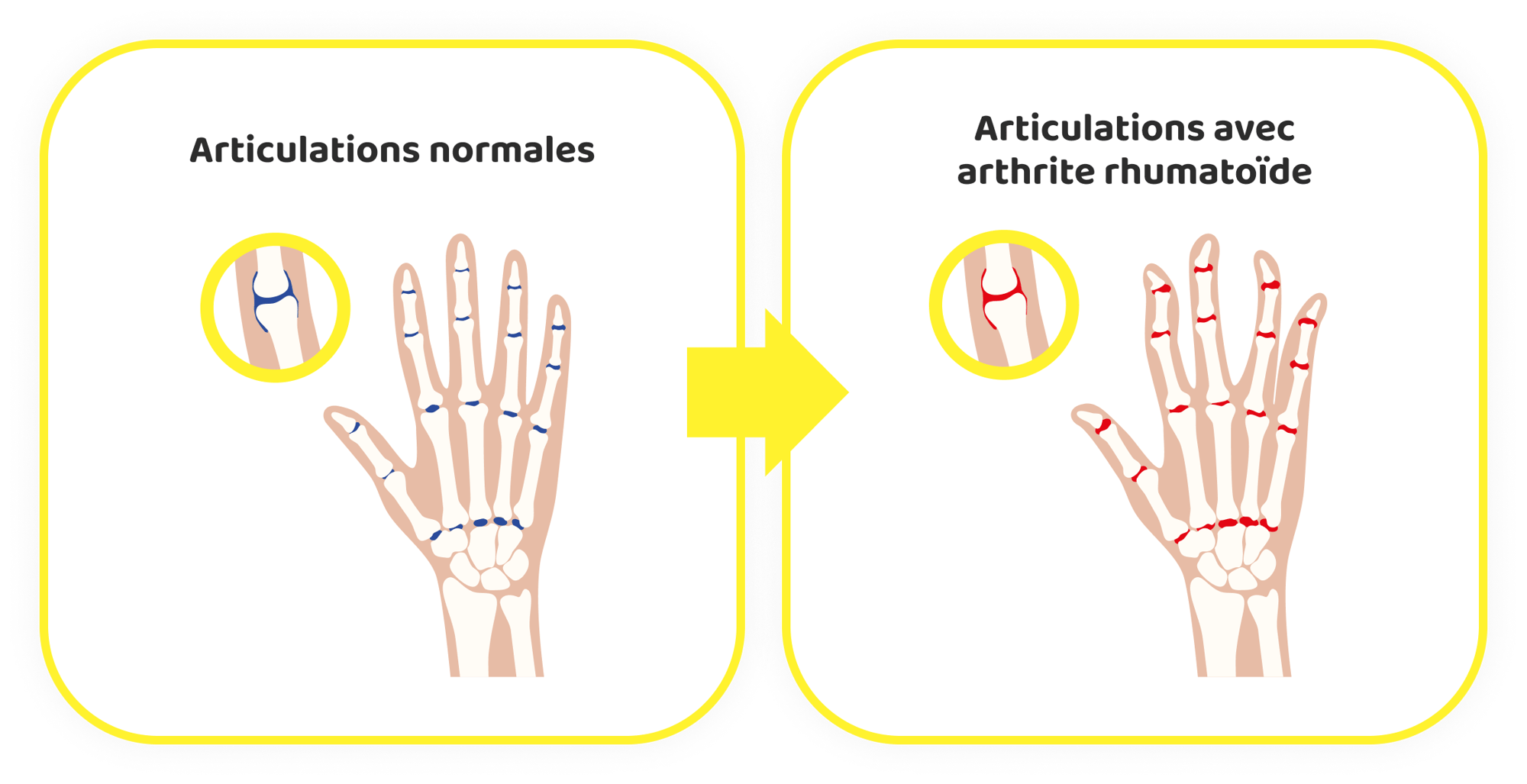 Rheumatoid Arthritis FR