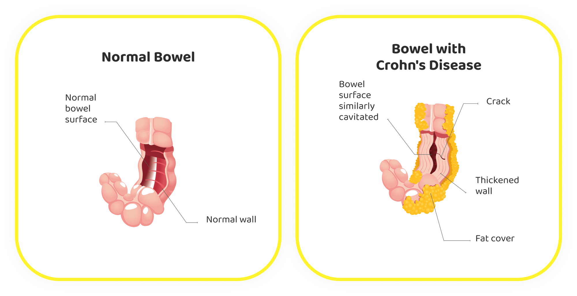 chrons disease