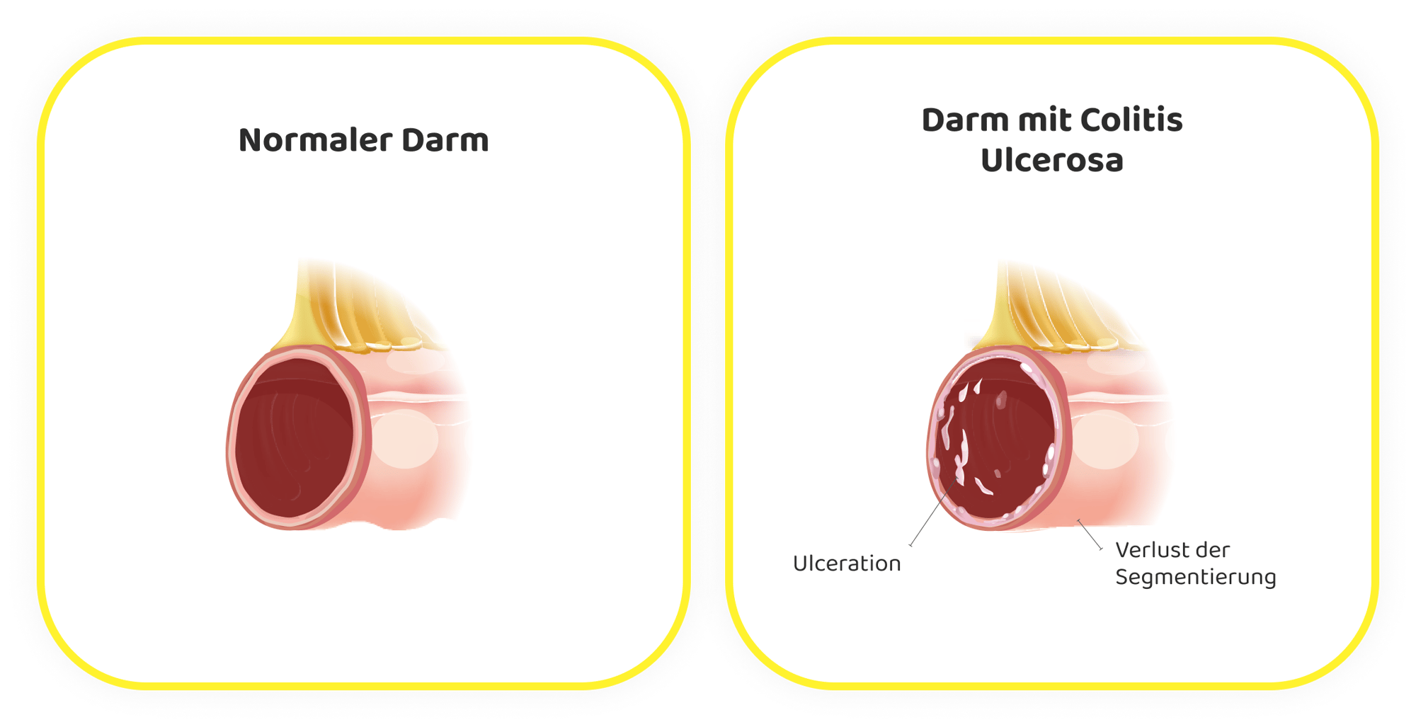 ulcerative colitis DE