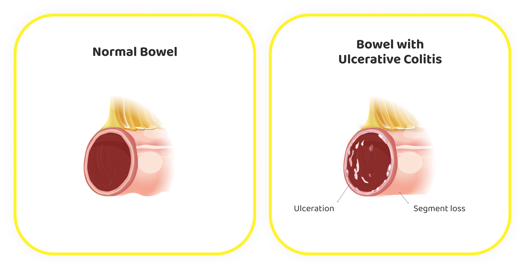 ulcerative colitis